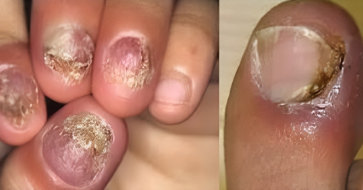 Paronychia Home Reamedy